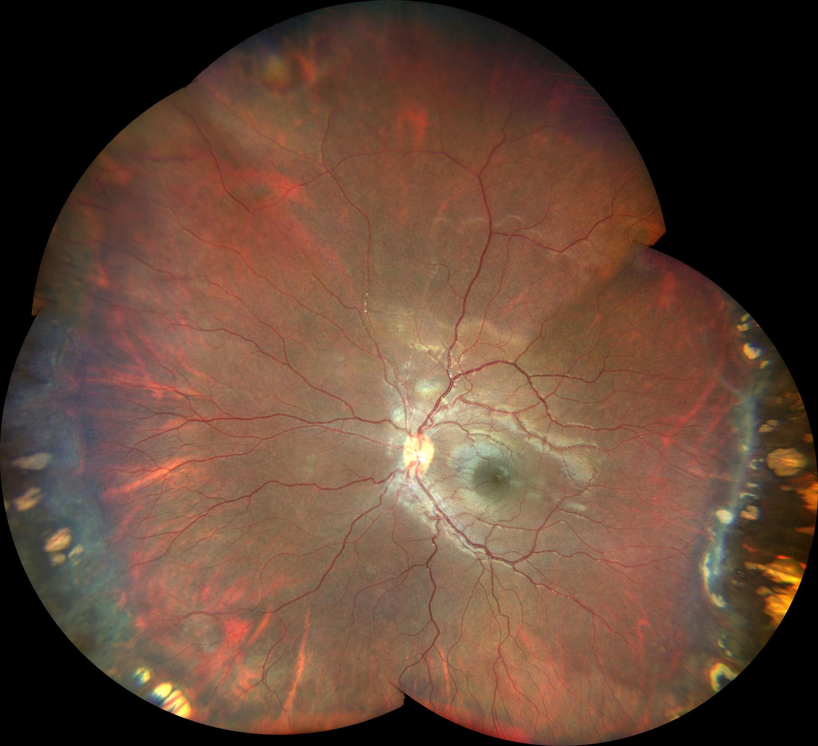 Retina Conditions Explained: Retinopathy of Prematurity (ROP ...